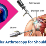 Shoulder Arthroscopy for Shoulder Pain