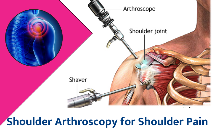 Shoulder Arthroscopy for Shoulder Pain