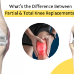 What’s the Difference Between Partial and Total Knee Replacements?