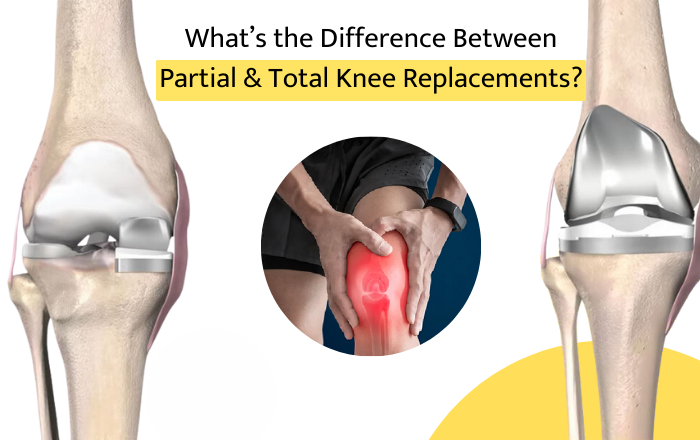 What’s the Difference Between Partial and Total Knee Replacements?