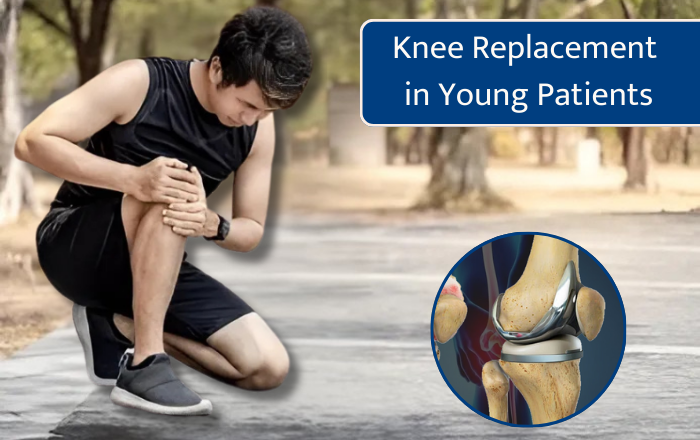 Knee Replacement in Young Patients