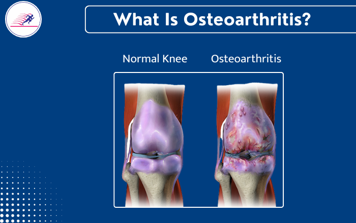 What Is Osteoarthritis? Symptoms, Causes, and Treatment Options